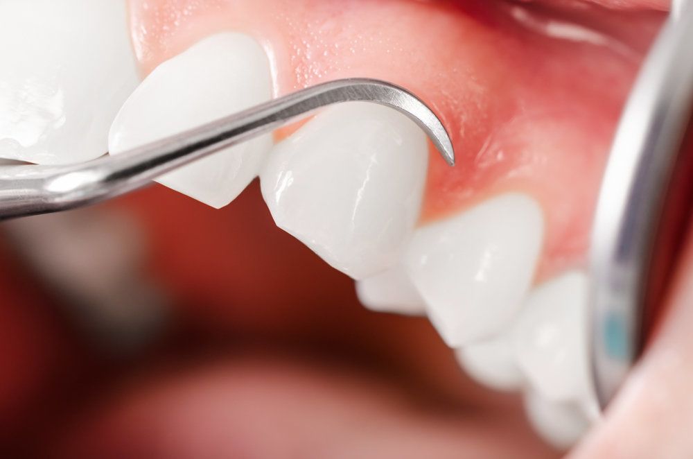 close up of dental cleaning