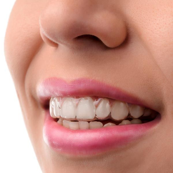 smile with Invisalign aligners