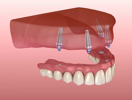 Al illustration of a denture being attached to four implants