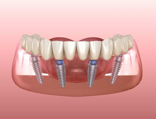 Al illustration of a denture that is attached to four implants