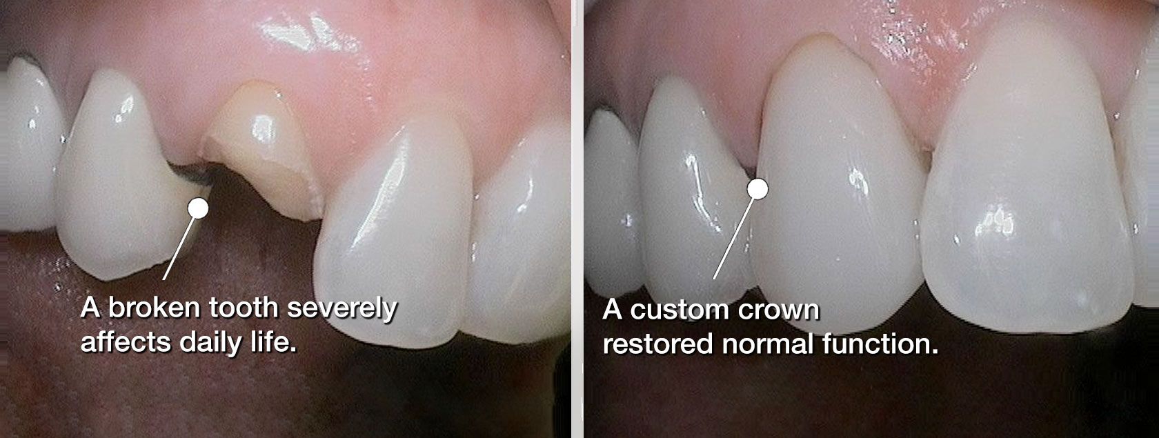 Before and after implant crown