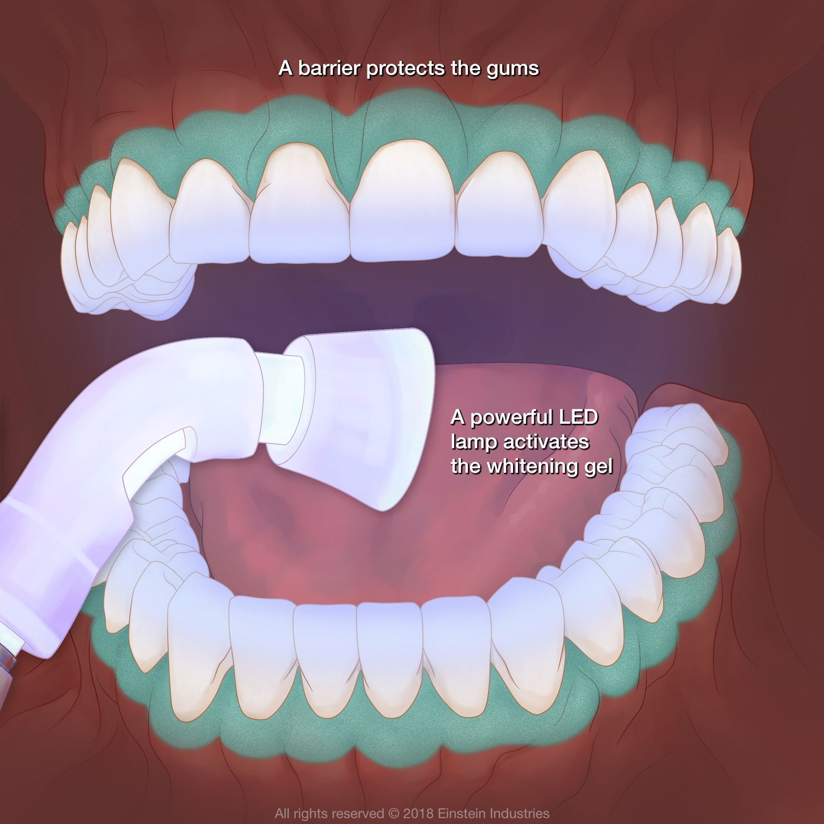 An illustration detailing how in-office whitening works