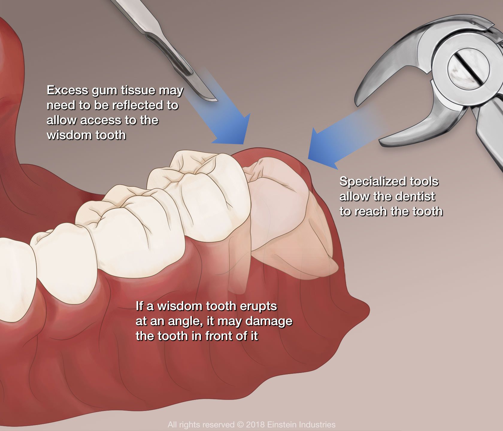 Diagram of steps in removing a wisdom tooth