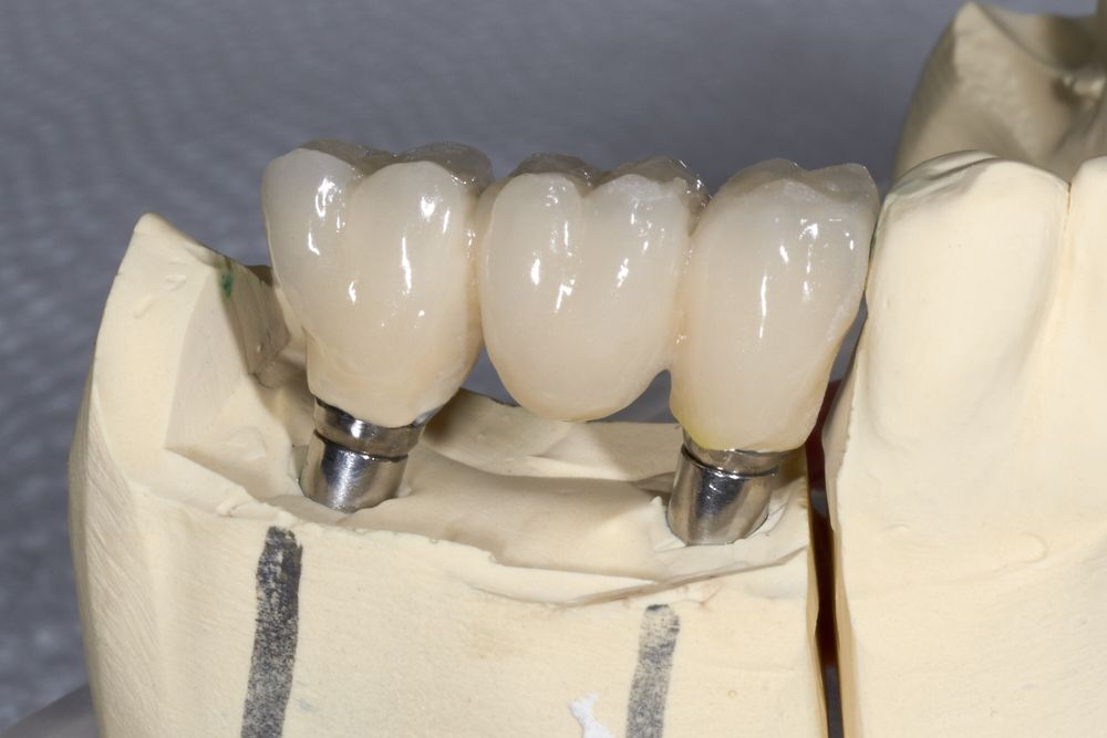 Jawbone model with dental implants attached